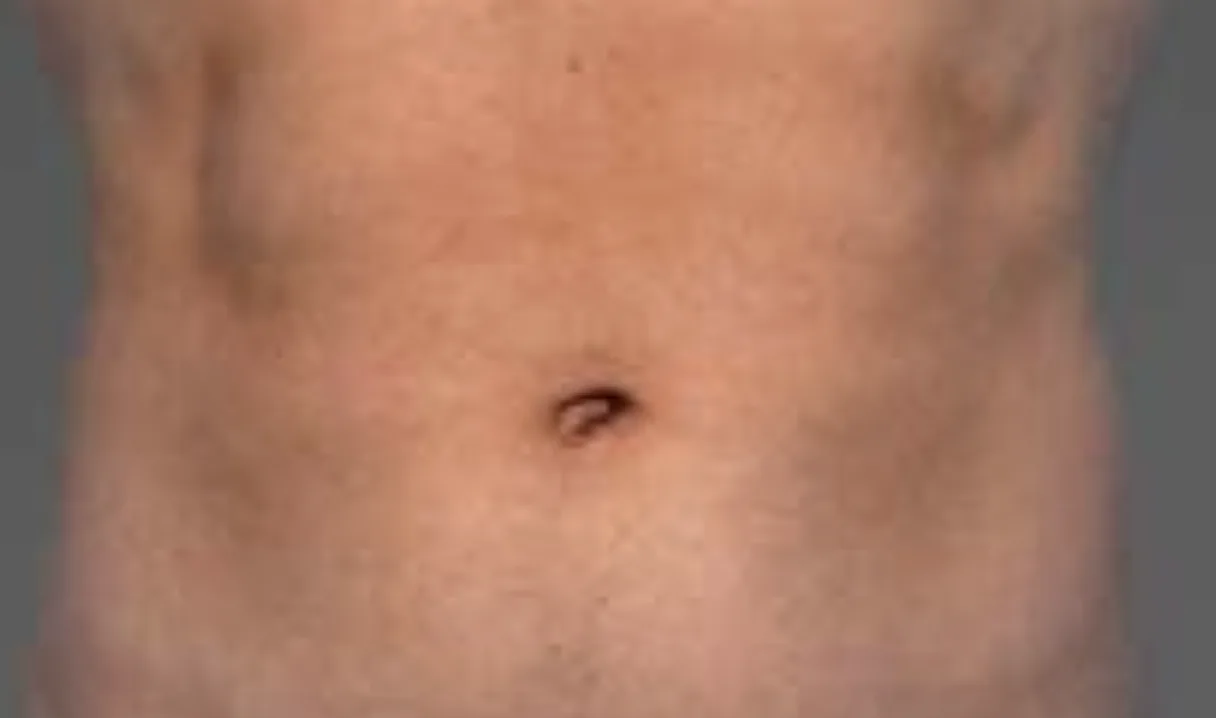 CoolTone abdomen before & After