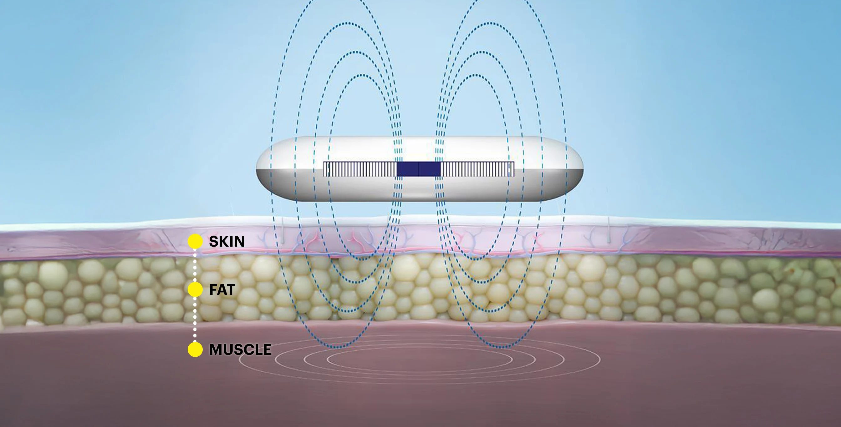 Drawing showcasing active magnetic pulse technology in action