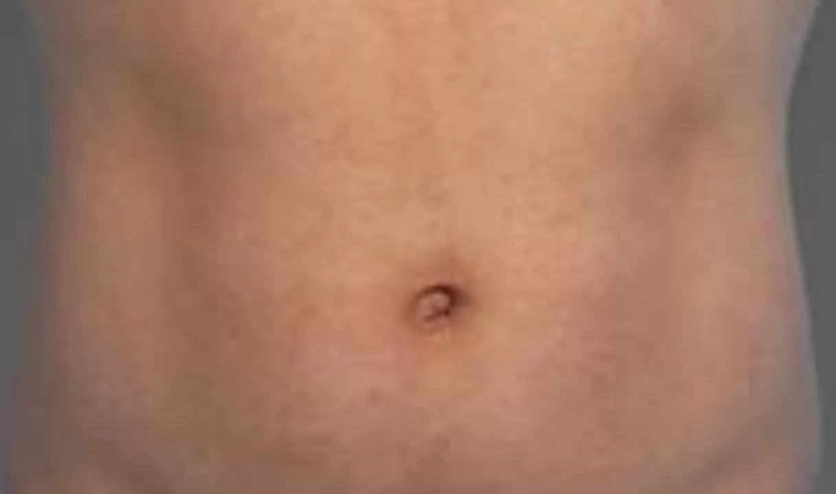 CoolTone abdomen before & After
