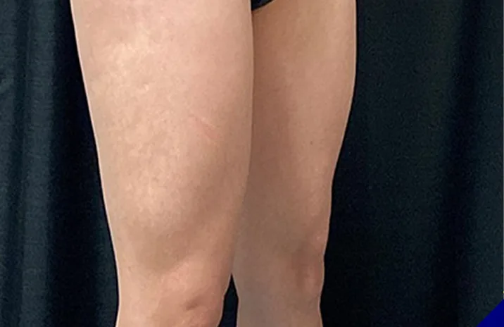 CoolTone thighs before & After