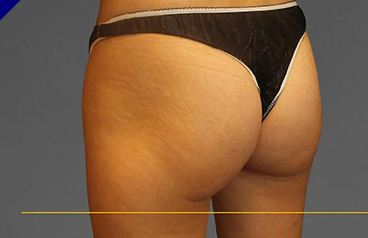 CoolTone buttock before & After