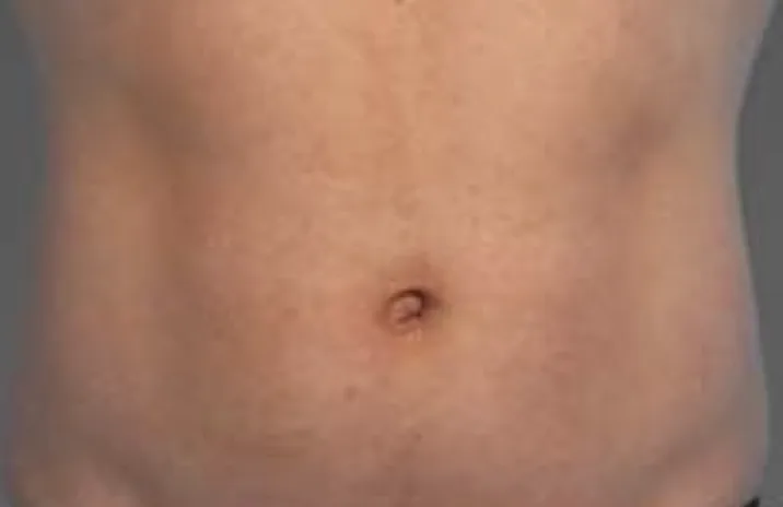 CoolTone abdomen before & After