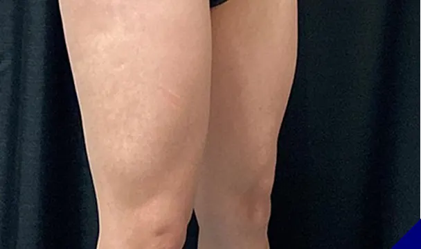 CoolTone thighs before & After