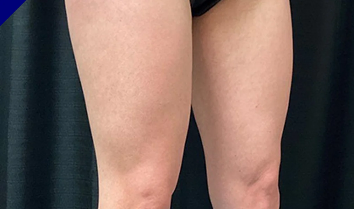 CoolTone thighs before & After