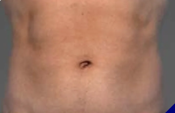 CoolTone abdomen before & After