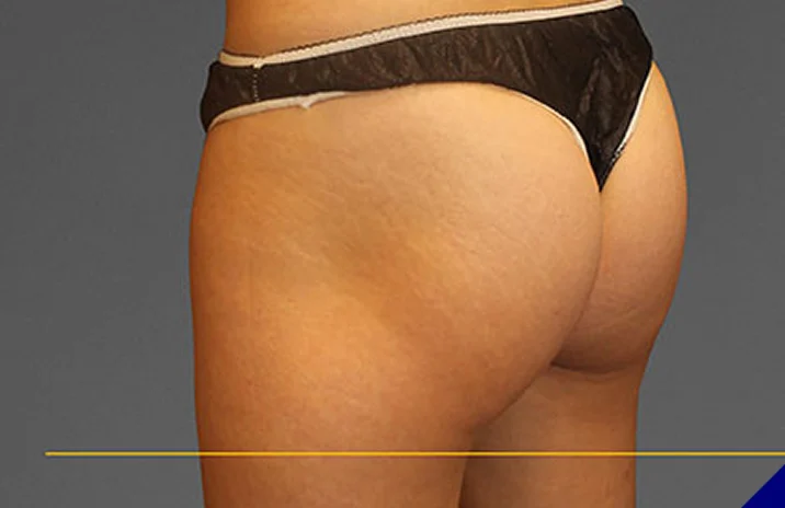 CoolTone buttock before & After
